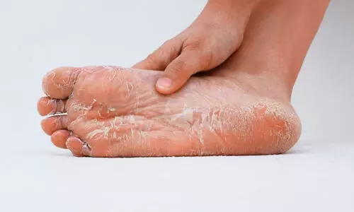 Diabetes Foot