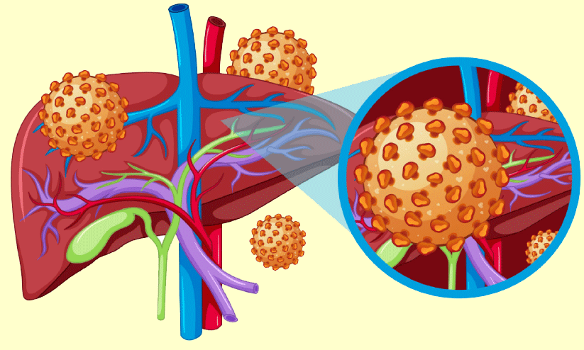 മഞ്ഞപ്പിത്തം; ജാഗ്രത നിർദേശവുമായി ആരോഗ്യ വകുപ്പ്