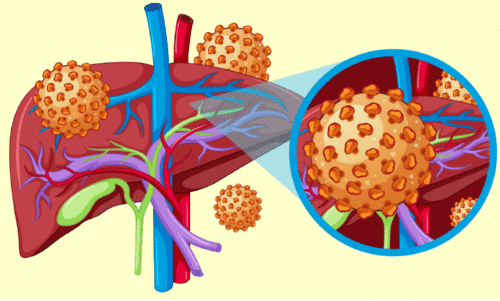 മഞ്ഞപ്പിത്തം; ജാഗ്രത നിർദേശവുമായി ആരോഗ്യ വകുപ്പ്