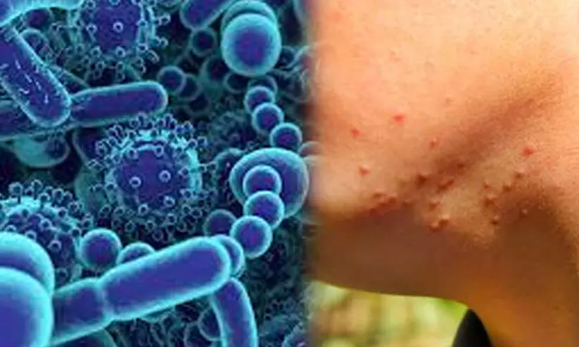 കോഴിക്കോട്ടെ 25കാരിയുടെ മരണകാരണം ചെള്ളുപനി കോഴിക്കോട്ടെ 25കാരിയുടെ മരണകാരണം ചെള്ളുപനി