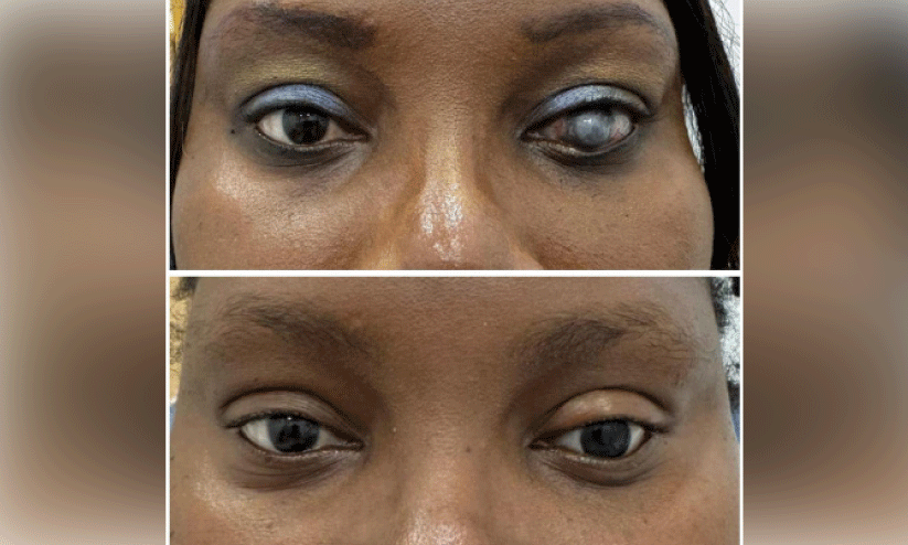 Ocular prosthesis surgery