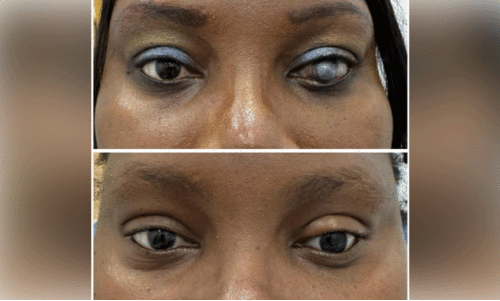 Ocular prosthesis surgery