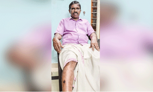 ഫണ്ട് പിരിവിനിടെ ലോക്കൽ സെക്രട്ടറിക്ക് നായുടെ കടിയേറ്റു