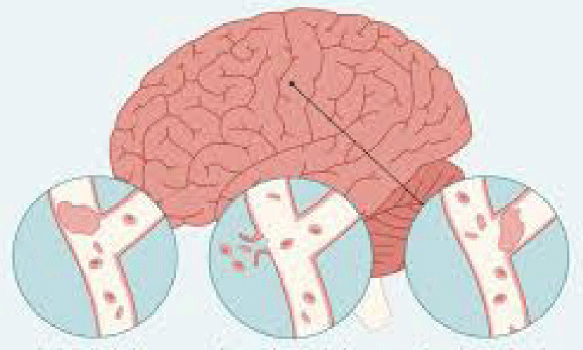 ‘അ​നാ​രോ​ഗ്യ​ക​ര​മാ​യ ജീ​വി​ത​ശൈ​ലി യു​വാ​ക്ക​ളി​ൽ പ​ക്ഷാ​ഘാ​തം വ​ർ​ധി​പ്പി​ക്കു​ന്നു’