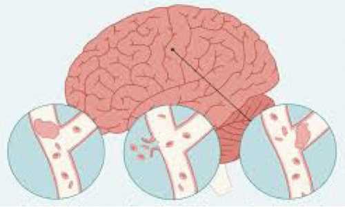 ‘അ​നാ​രോ​ഗ്യ​ക​ര​മാ​യ ജീ​വി​ത​ശൈ​ലി യു​വാ​ക്ക​ളി​ൽ പ​ക്ഷാ​ഘാ​തം വ​ർ​ധി​പ്പി​ക്കു​ന്നു’