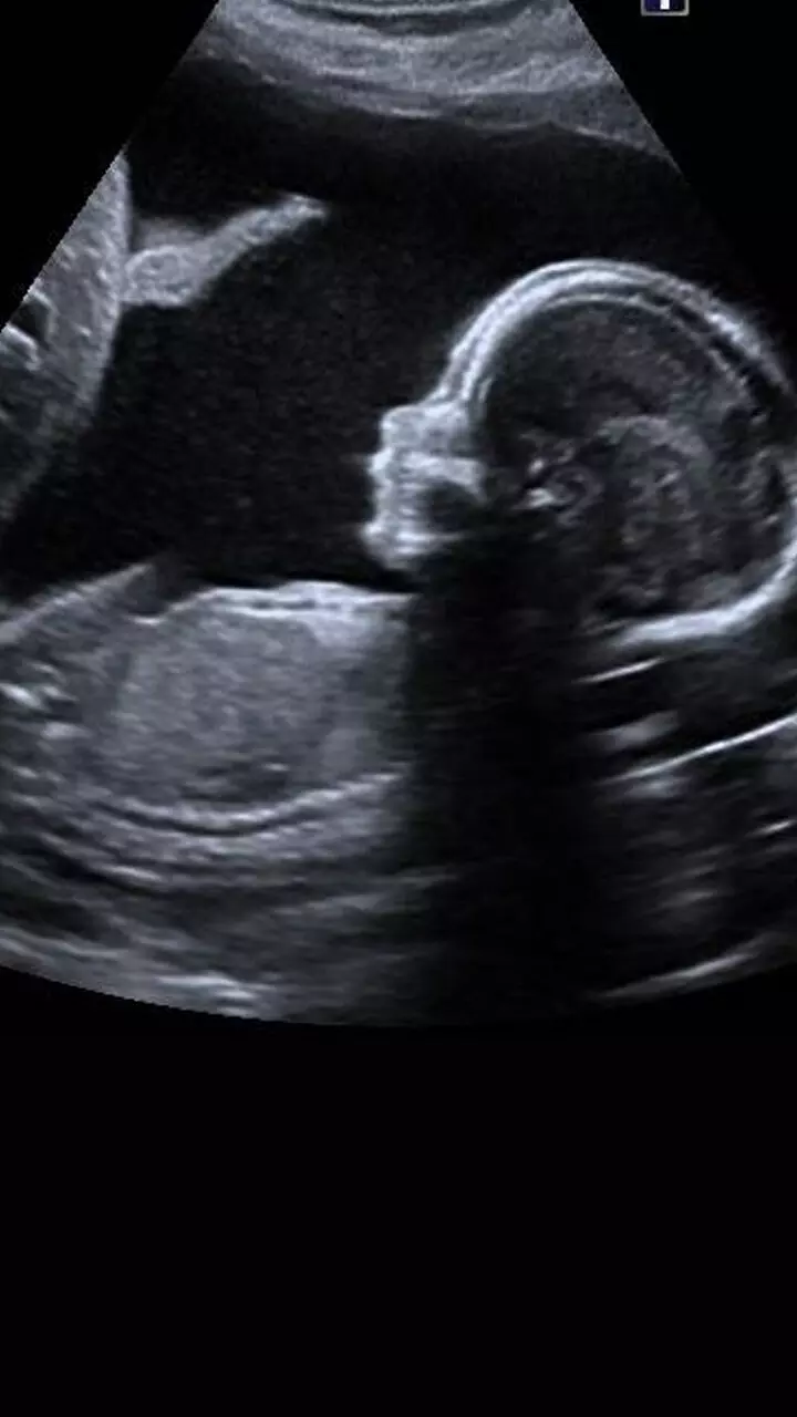 ഗർഭസ്ഥ ശിശു: അനോമിലി സ്കാനിങ്ങിൽ എല്ലാം അറിയാനാകുമോ?