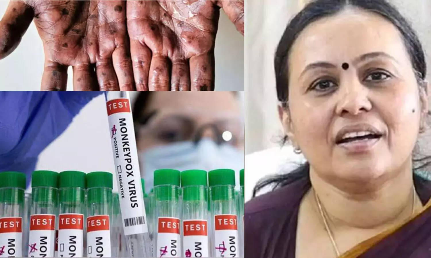 കണ്ണൂരിൽ ഒരാൾക്കുകൂടി എം പോക്സ് സ്ഥിരീകരിച്ചു; ചികിത്സയിലുള്ളയാളുടെ നില തൃപ്തികരം