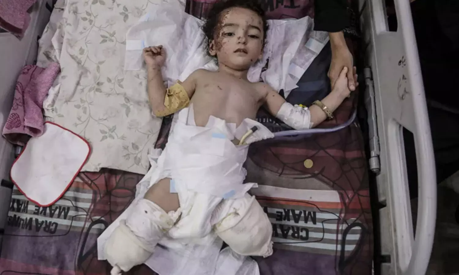 അവർ അവൾക്ക് ആദ്യം പോളിയോ വാക്സിൻ നൽകി; പിന്നെ കാലുകൾ ബോംബിട്ടു തകർത്തു