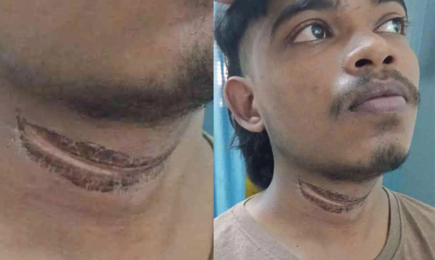 റോഡിൽ പൊട്ടി കിടന്ന കേബിൾ കഴുത്തിൽ കുരുങ്ങി ബൈക്ക് യാത്രികർക്ക് പരിക്ക്