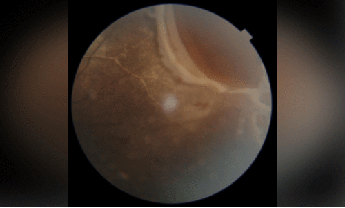 ക്രി​ക്ക​റ്റ് പ​ന്ത്​ കൊ​ണ്ട്​ ക​ണ്ണി​ന് പ​രി​ക്കേ​റ്റ  കു​ട്ടി​യു​ടെ കാ​ഴ്ച വീ​ണ്ടെ​ടു​ത്ത് ആ​സ്റ്റ​ര്‍