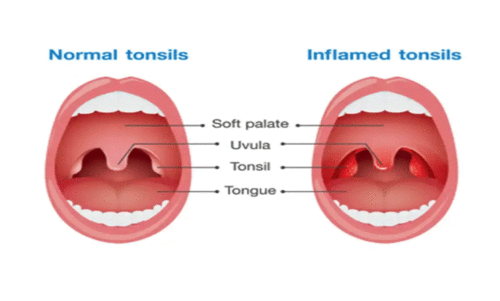 കാ​ലാ​വ​സ്ഥ; ടോ​ൺ​സി​ലൈ​റ്റി​സ് രോ​​ഗം വ​ർ​ധി​ക്കു​ന്നു
