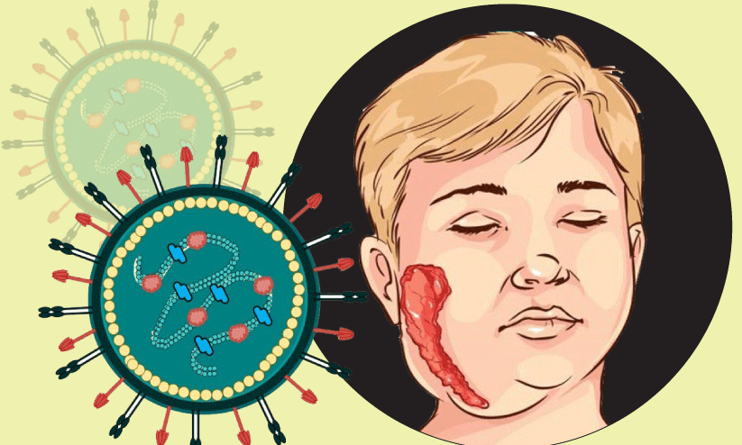 മുണ്ടിനീര് നിസ്സാരമാക്കരുത് മുണ്ടിനീര് നിസ്സാരമാക്കരുത്