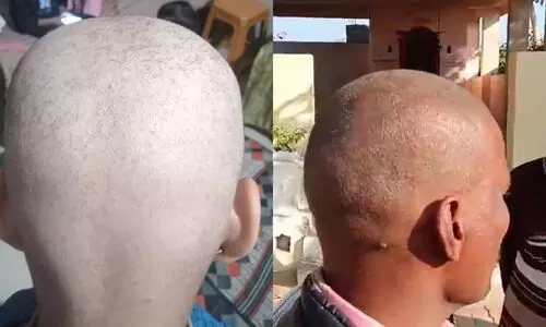 ദിവസങ്ങൾക്കകം മുടി കൊഴിഞ്ഞ് മൊട്ടയാവുന്നു; ആശങ്കയിൽ മൂന്ന് ഗ്രാമങ്ങൾ