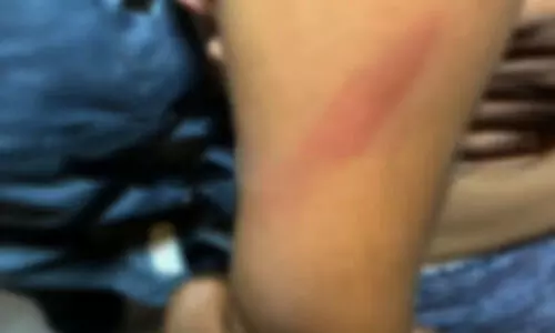 രണ്ടര വയസുകാരിക്ക് അങ്കണവാടി ടീച്ചറുടെ ക്രൂരമർദനം; കമ്പി കൊണ്ട് അടിച്ചെന്നാണ് പരാതി