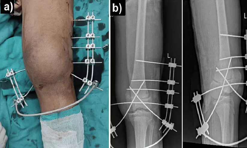 ഇന്ത്യയിൽ ശസ്ത്രക്രിയാ അണുബാധ നിരക്ക് ഉയർന്ന തോതിലെന്ന് ഐ.സി.എം.ആർ പഠനം