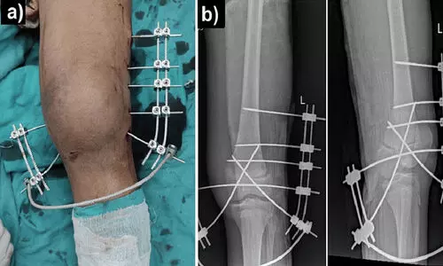 ഇന്ത്യയിൽ ശസ്ത്രക്രിയാ അണുബാധ നിരക്ക് ഉയർന്ന തോതിലെന്ന് ഐ.സി.എം.ആർ പഠനം