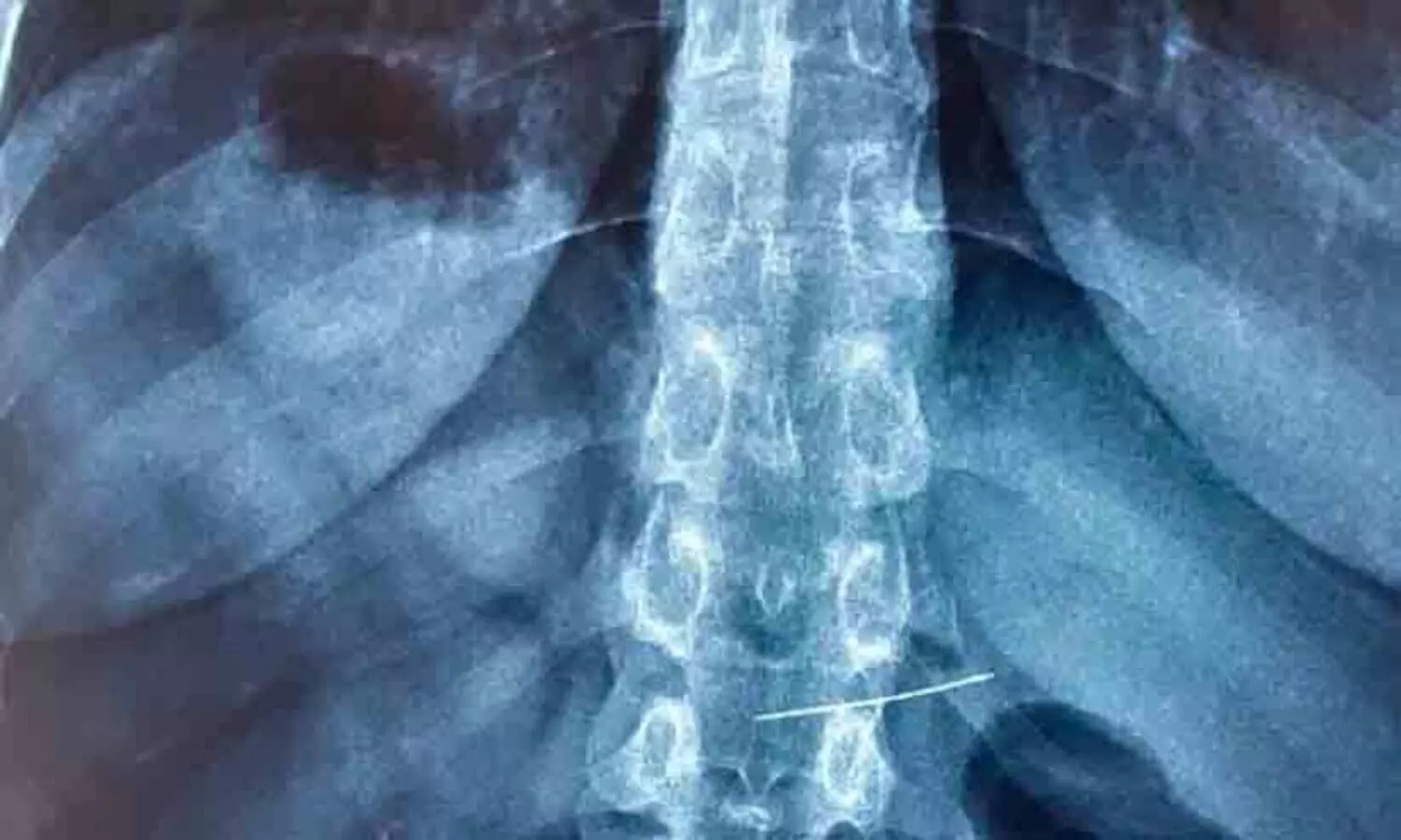 കുട്ടി അബദ്ധത്തിൽ വിഴുങ്ങിയ സൂചി പുറത്തെടുത്തു