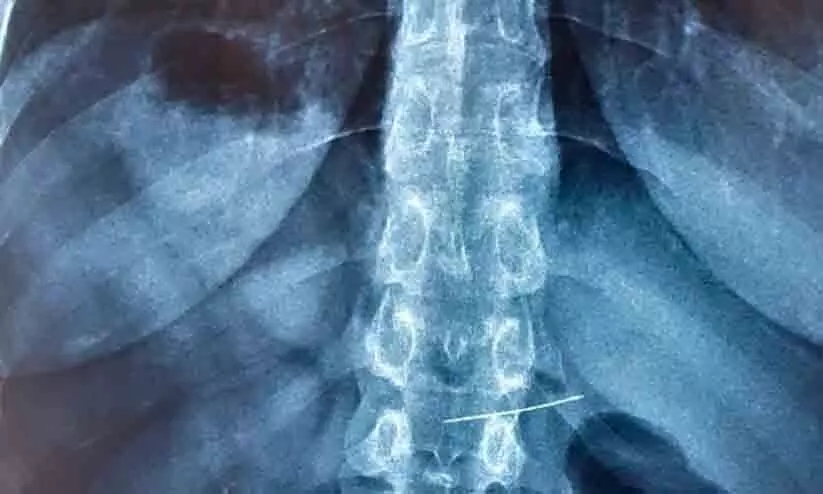 കുട്ടി അബദ്ധത്തിൽ വിഴുങ്ങിയ സൂചി പുറത്തെടുത്തു കുട്ടി അബദ്ധത്തിൽ വിഴുങ്ങിയ സൂചി പുറത്തെടുത്തു