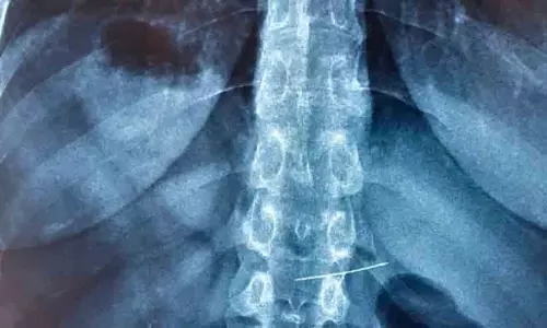 കുട്ടി അബദ്ധത്തിൽ വിഴുങ്ങിയ സൂചി പുറത്തെടുത്തു