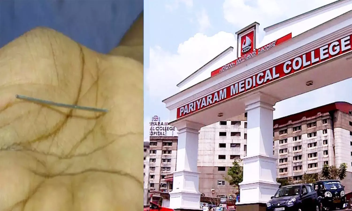 നവജാത ശിശുവിന്റെ തുടയിൽ സൂചി; കണ്ണൂർ  മെഡിക്കൽ കോളജിലെ ഡോക്ടര്‍ക്കും ജീവനക്കാര്‍ക്കുമെതിരെ കേസ്