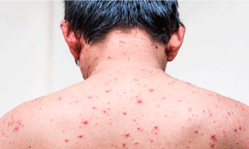 ഒന്നരമാസത്തിനിടെ 273പേർ ചികിത്സതേടി; ആശങ്കയേറ്റി ചിക്കൻപോക്സ്