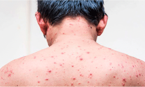 ഒന്നരമാസത്തിനിടെ 273പേർ ചികിത്സതേടി; ആശങ്കയേറ്റി ചിക്കൻപോക്സ്