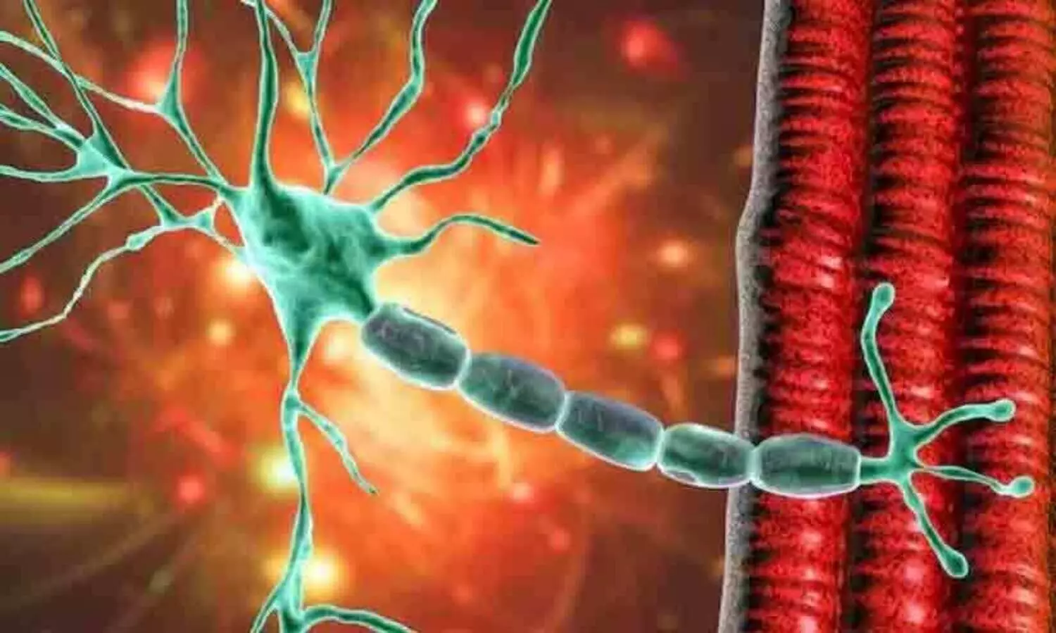 Guillain Barre Syndrome