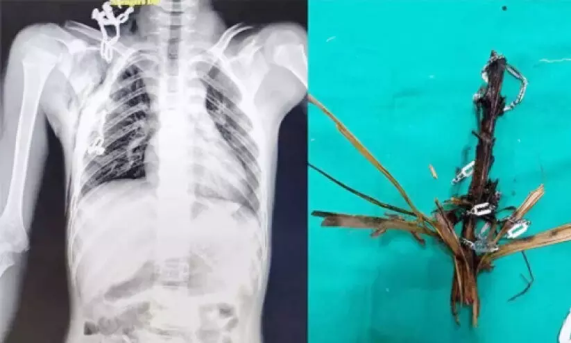 നെ​ഞ്ചി​ൽ ത​റ​ച്ചു​ക​യ​റി​യ ഓ​ല​മ​ട​ലും മാ​ല​യും പു​റ​ത്തെ​ടു​ത്തു