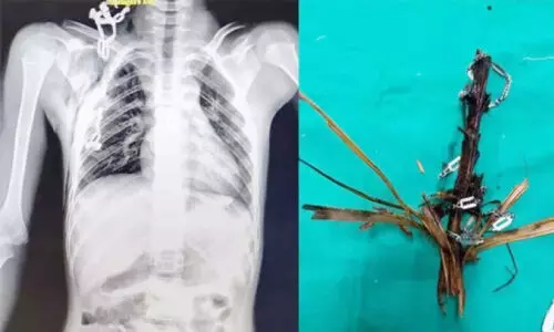 നെ​ഞ്ചി​ൽ ത​റ​ച്ചു​ക​യ​റി​യ ഓ​ല​മ​ട​ലും മാ​ല​യും പു​റ​ത്തെ​ടു​ത്തു