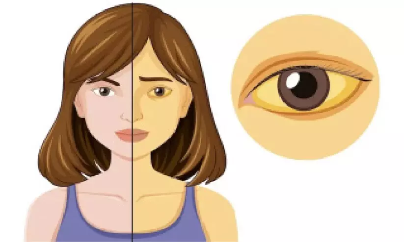 മഞ്ഞപ്പിത്തത്തിനെതിരെ ജാഗ്രത പുലർത്തണം -ഡി.എം.ഒ