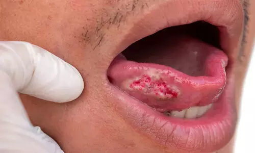 ഇന്ത്യക്കാരിൽ വായയിലെ അർബുദം വർധിക്കുന്നു; പകുതിയിലധികം രോഗികളും പുകയിലയോ മദ്യമോ ഉപയോഗിക്കാത്തവരെന്ന് പഠനം