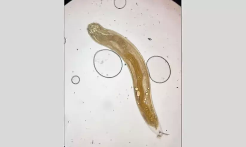 യുവതിയുടെ കണ്ണിൽ ജീവനുള്ള വിര! ശസ്ത്രക്രിയയിലൂടെ പുറത്തെടുത്തു യുവതിയുടെ കണ്ണിൽ ജീവനുള്ള വിര! ശസ്ത്രക്രിയയിലൂടെ പുറത്തെടുത്തു