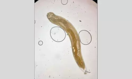 യുവതിയുടെ കണ്ണിൽ ജീവനുള്ള വിര! ശസ്ത്രക്രിയയിലൂടെ പുറത്തെടുത്തു