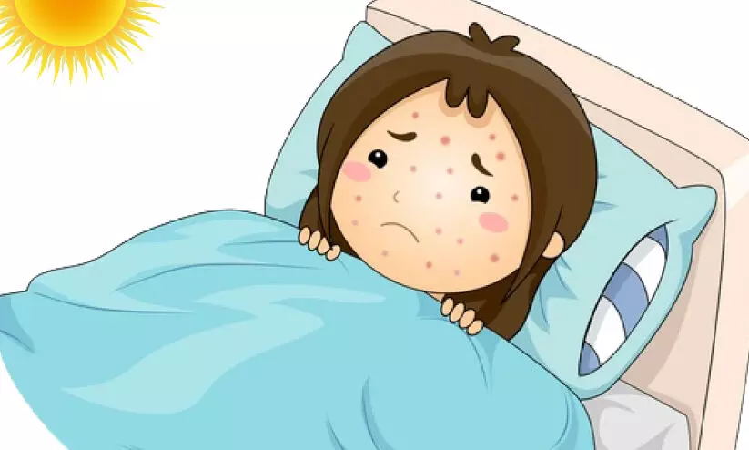 വൈറൽപനിയും പടരുന്നു; ചൂടും ഒപ്പം ചിക്കന്പോക്സും വൈറൽപനിയും പടരുന്നു; ചൂടും ഒപ്പം ചിക്കന്പോക്സും