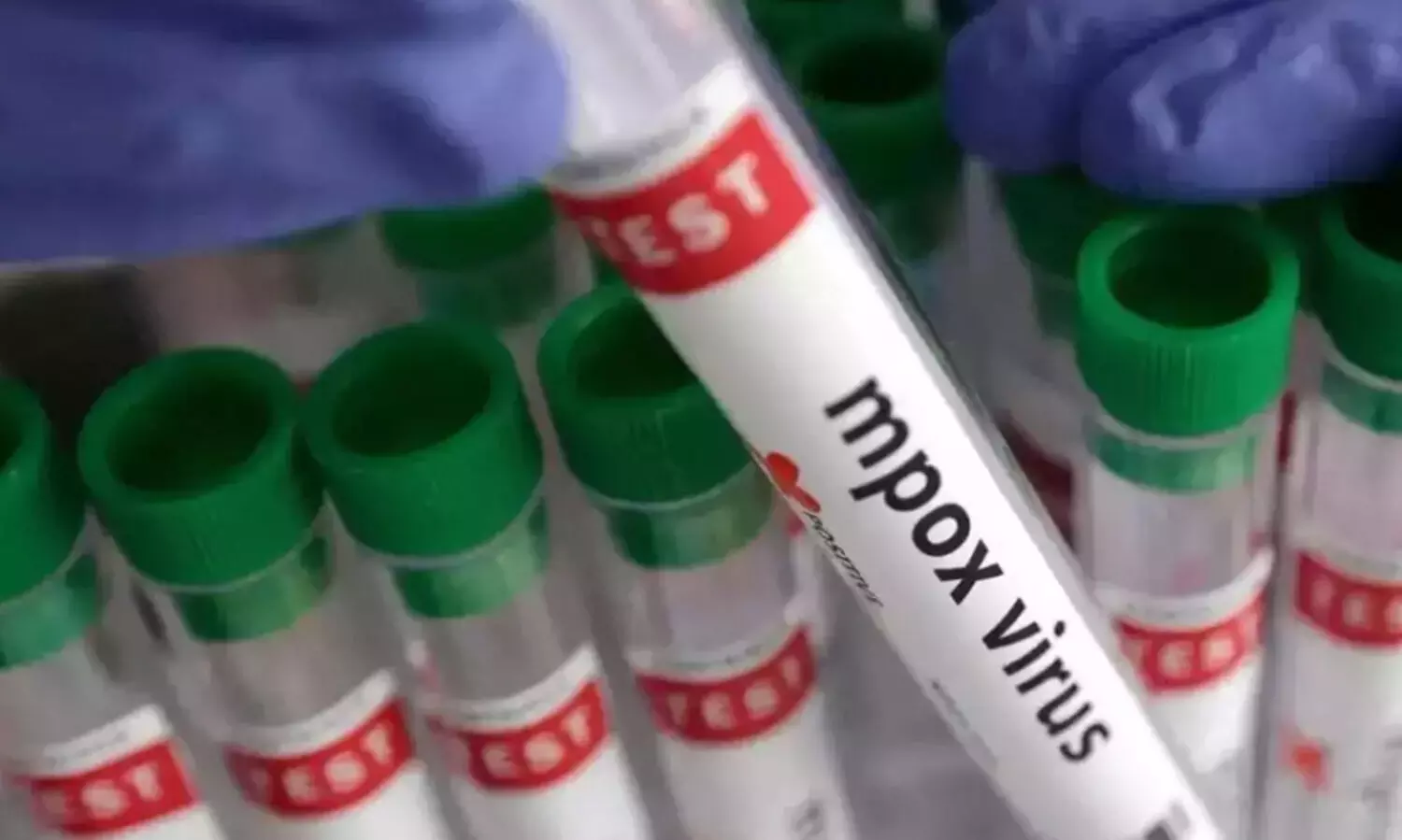 കാസർകോട് മങ്കി പോക്സ് സ്ഥിരീകരിച്ചു; രോഗം ദുബൈയിൽനിന്ന് വന്ന യുവാവിന്