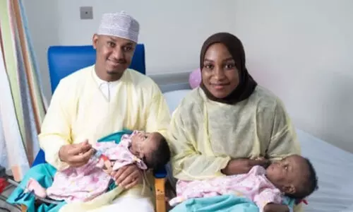 സയാമീസ് ഇരട്ടകളെ വേർപ്പെടുത്തി; അപൂർവ നേട്ടവുമായി ഒമാൻ