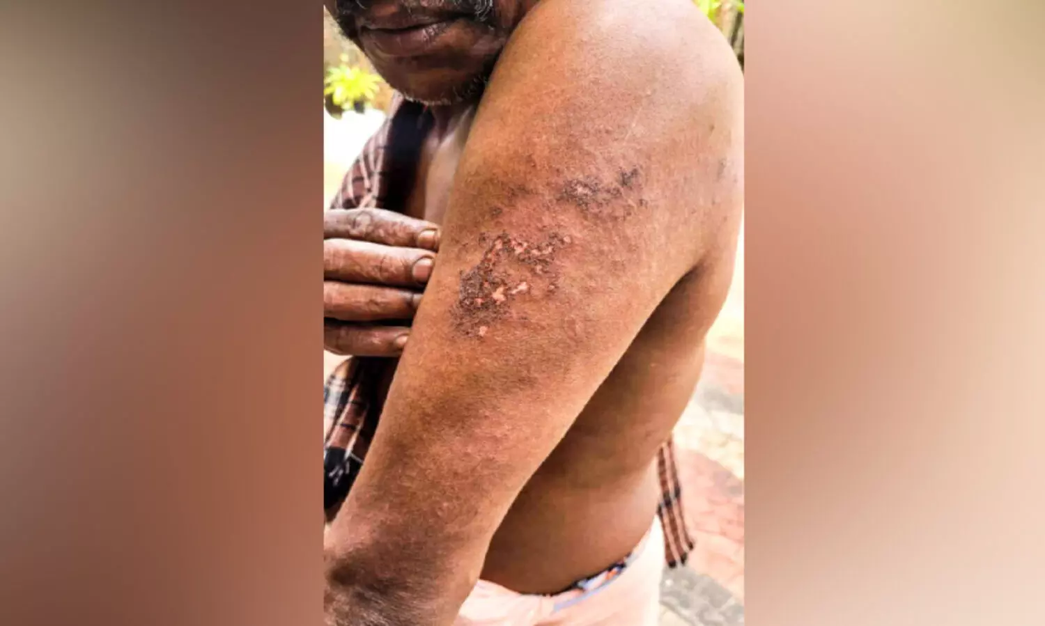 കെട്ടിട നിർമാണത്തൊഴിലാളിക്ക് സൂര്യാതപമേറ്റു