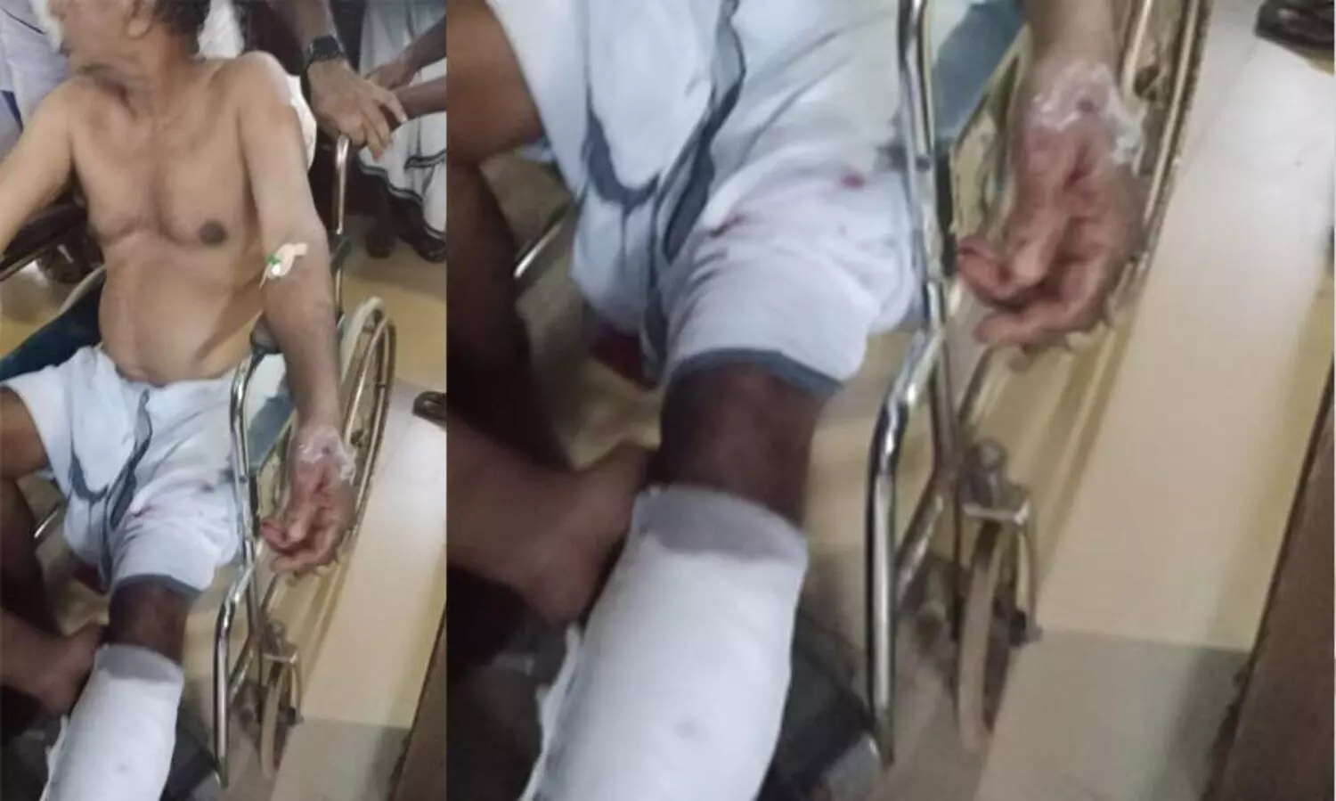 കക്കട്ടിൽ ഒരാൾക്ക് വെട്ടേറ്റു; അക്രമി എത്തിയത് മഴക്കോട്ടു കൊണ്ട്​ മുഖം മറച്ച്​