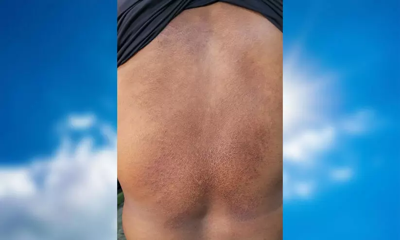 sunburn 989798 sunburn 989798