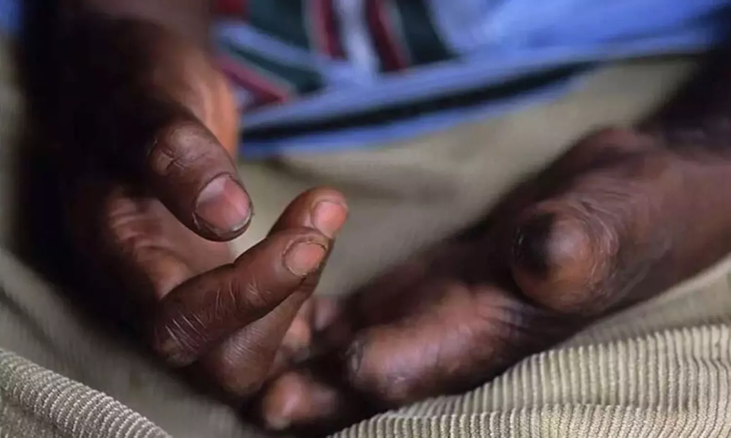 കു​ഷ്ഠ​രോ​ഗം; പ്ര​തി​രോ​ധ പ്ര​വ​ർ​ത്ത​നം ഊ​ർ​ജി​തം