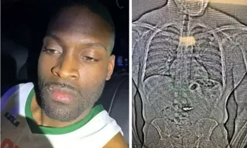 കള്ളന്‍ വിഴുങ്ങിയത് ആറ് കോടിയുടെ കമ്മല്‍; അമേരിക്കൻ പൊലീസ് കാത്തിരുന്നത് രണ്ടാഴ്ച