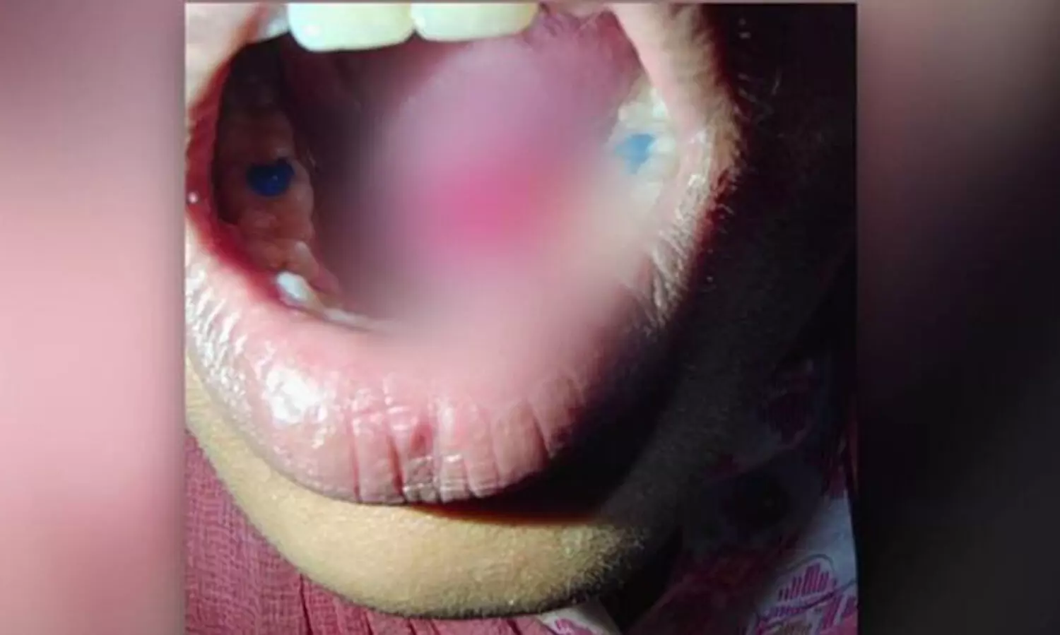 പല്ലിൽ കമ്പിയിട്ടതിന്‍റെ ഗം മാറ്റാനെത്തിയ യുവതിക്ക് നാക്കിൽ ഡ്രില്ലർ തട്ടി മുറിവേറ്റു; ഡെന്‍റൽ ക്ലിനിക്കിനെതിരെ കേസ്