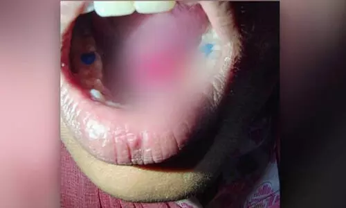 പല്ലിൽ കമ്പിയിട്ടതിന്‍റെ ഗം മാറ്റാനെത്തിയ യുവതിക്ക് നാക്കിൽ ഡ്രില്ലർ തട്ടി മുറിവേറ്റു; ഡെന്‍റൽ ക്ലിനിക്കിനെതിരെ കേസ്