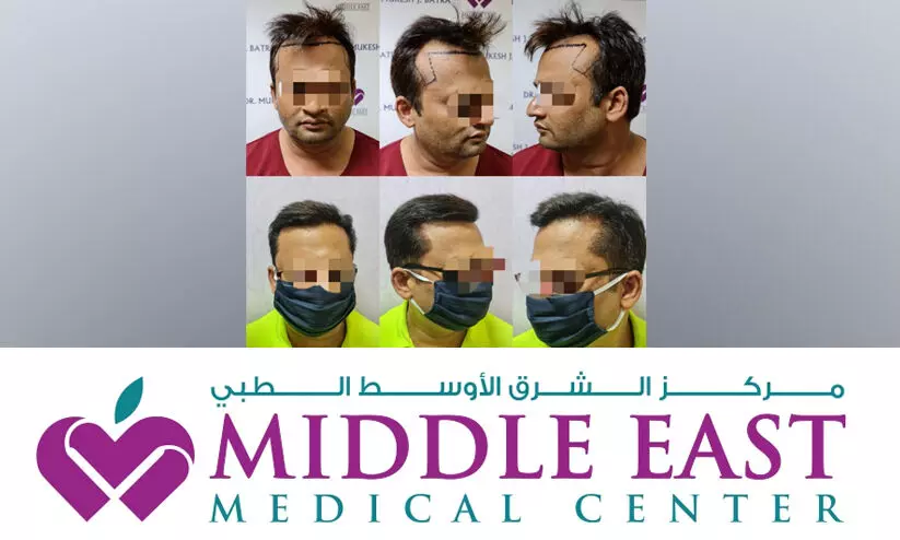 മൈക്രോ എഫ്.യു.ഇ; മുടികൊഴിച്ചിലിന് ആധുനിക പരിഹാരം