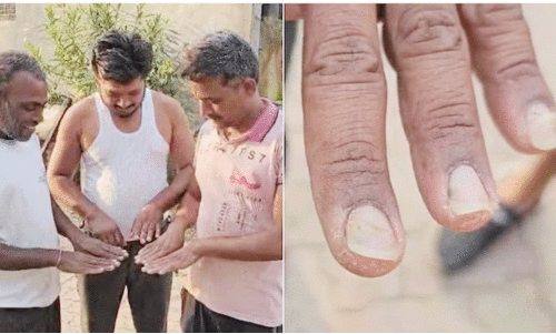 മഹാരാഷ്ട്രയിൽ അപൂർവ രോഗം; നഖങ്ങൾ കൊഴിഞ്ഞു പോകുന്നു