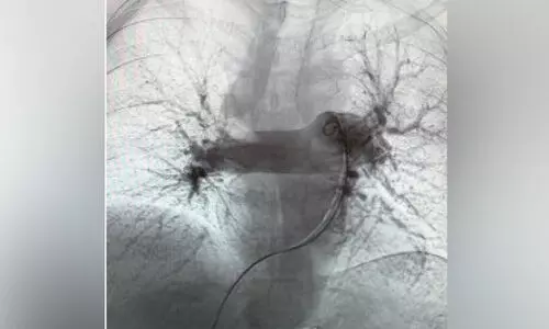 ര​ക്തം ക​ട്ട​പി​ടി​ക്കാ​തിരിക്കാൻ ആ​ൽ​ഫാ​വാ​ക് സാ​ങ്കേ​തി​ക​വി​ദ്യ ഉ​പ​യോ​ഗി​ച്ച് ഒ​മാ​ൻ