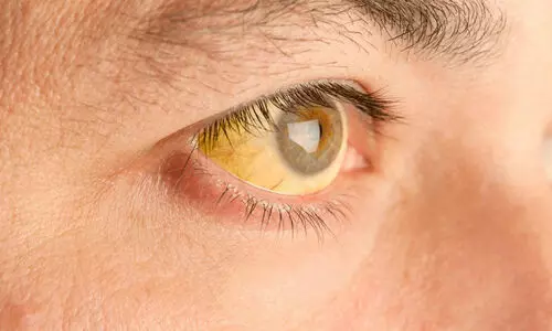 മ​ഞ്ഞ​പ്പി​ത്തം വർധിക്കുന്നു.; ജാ​ഗ്ര​ത വേ​ണം