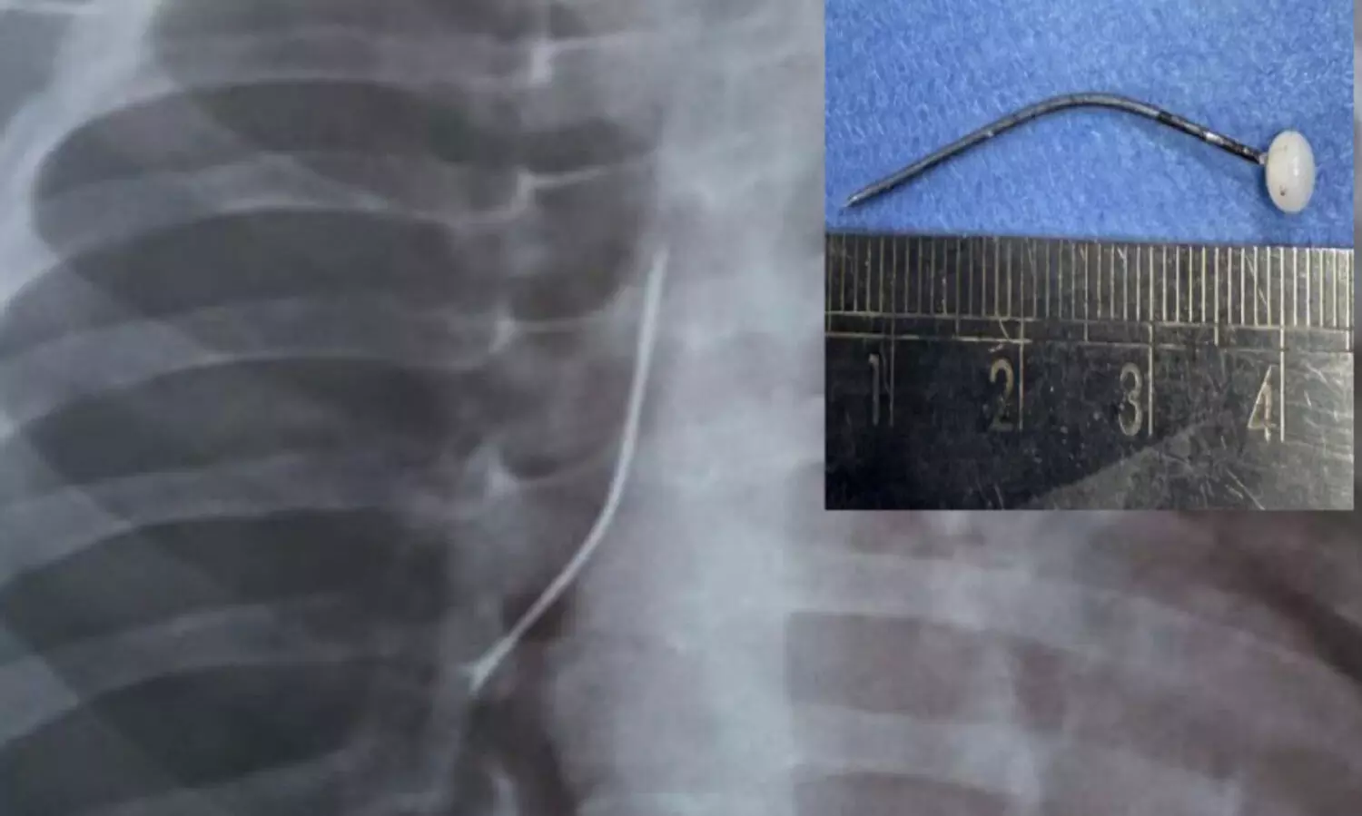 പിഞ്ചുകുഞ്ഞിന്റെ ശ്വാസനാളത്തിൽനിന്ന്​ നാ​ല്​ സെ​ന്റീ​മീ​റ്റ​ർ നീ​ള​മു​ള്ള സേഫ്റ്റി പിൻ പുറത്തെടുത്തു