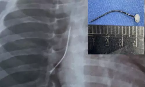 പിഞ്ചുകുഞ്ഞിന്റെ ശ്വാസനാളത്തിൽനിന്ന്​ നാ​ല്​ സെ​ന്റീ​മീ​റ്റ​ർ നീ​ള​മു​ള്ള സേഫ്റ്റി പിൻ പുറത്തെടുത്തു