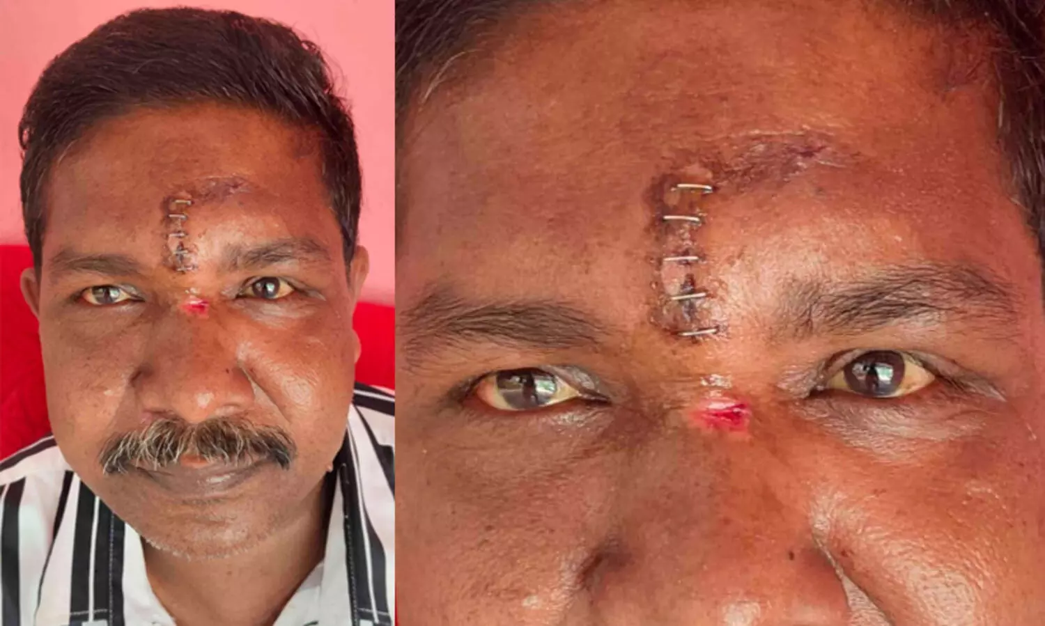 തുന്നിക്കെട്ടിയ മുറിവിൽ അസഹനീയ വേദന, സ്കാനിങ്ങിൽ ഉറുമ്പുകൾ; റിപ്പോർട്ട് തേടി ആരോഗ്യ വകുപ്പ്